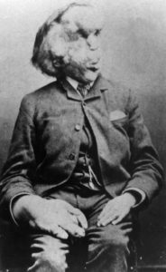 Joseph_Merrick_carte_de_visite_photo,_c._1889